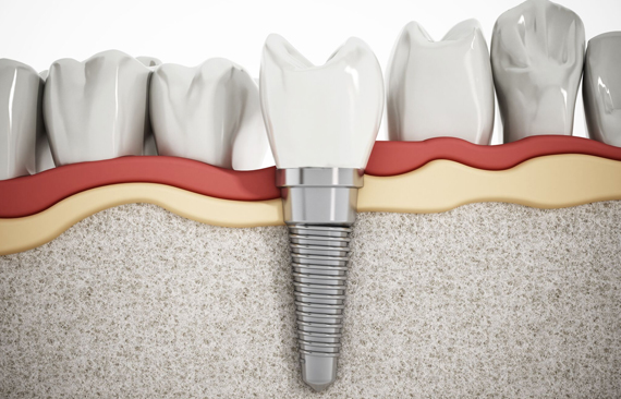 Dental Implants Are A Great Way To Improve