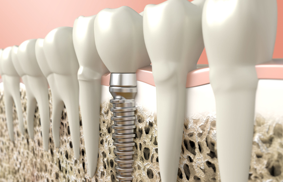 Dental Implants Are Typically Made Of Titanium