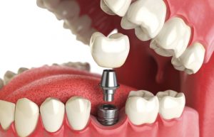 What Are Dental Implants