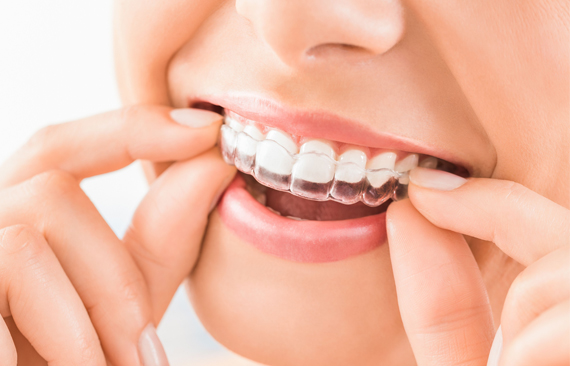 What Are Invisalign Or Clear Aligners