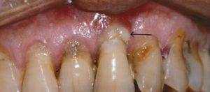 Periodontal Diseases – A Full Guide Scaled Olgawie9f59zj81hog4x90y101dx4a3mtok99vbma0