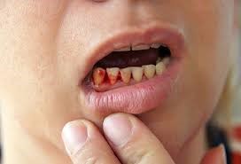 Teeth Experience Gum Infections