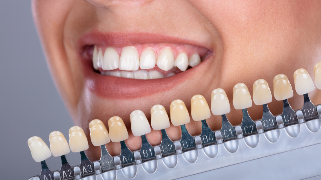 teeth whitening Grand Prairie