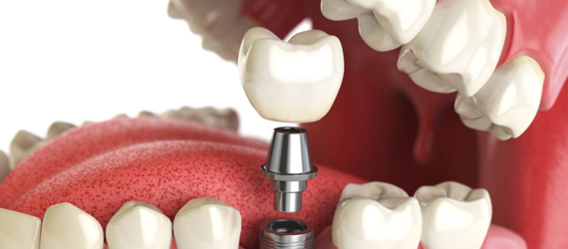 What Are Dental Implants